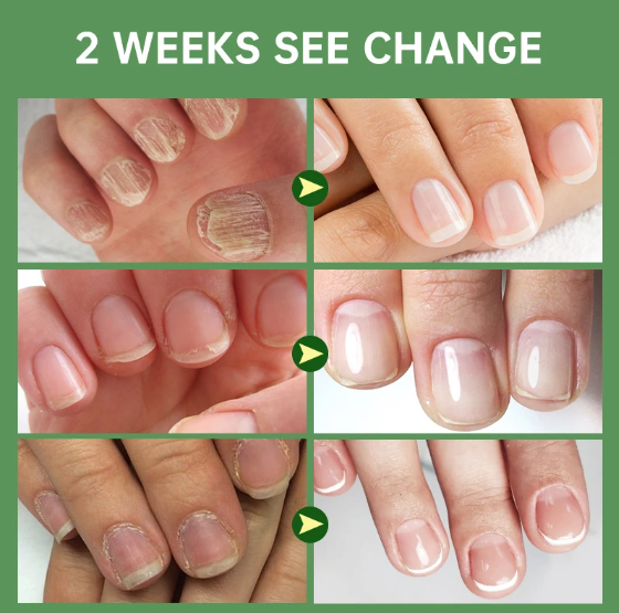 300K (COMPRA 1 & LLEVA 2)🎁Base Uñas 4K +Potente🙅♀️ +Crecimiento & Hongos AVANZADO 300%