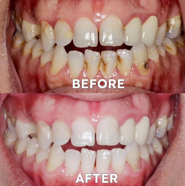 ✨Mineral ODALIT™ Restaura en caries & dientes oscuros✨