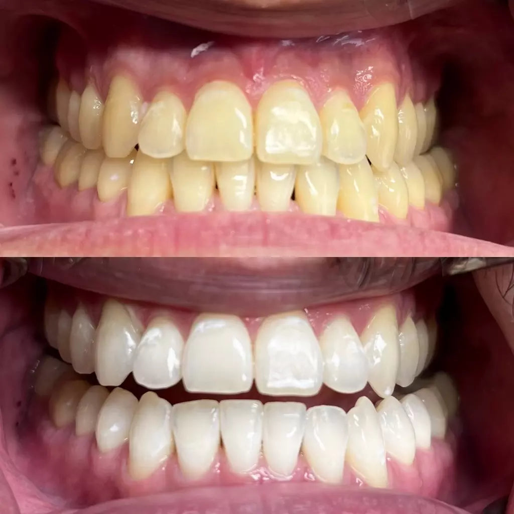 ENVÍO GRATIS🔥𝙈𝙞𝙣𝙚𝙧𝙖𝙡 𝙍𝙚𝙨𝙩𝙖𝙪𝙧𝙖𝙙𝙤𝙧 𝙎𝙤𝙣𝙧𝙞𝙨𝙖😍caries y manchas